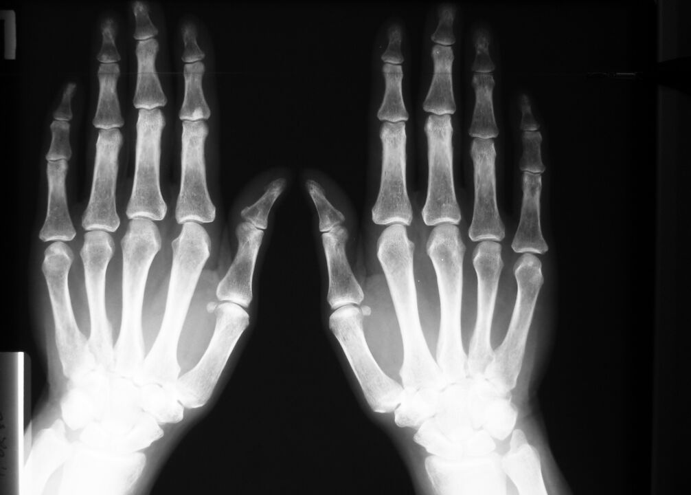 rentgen za diagnosticiranje bolečine v sklepih prstov